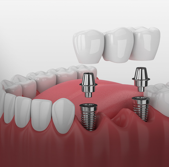 Treatment - 23 Dental